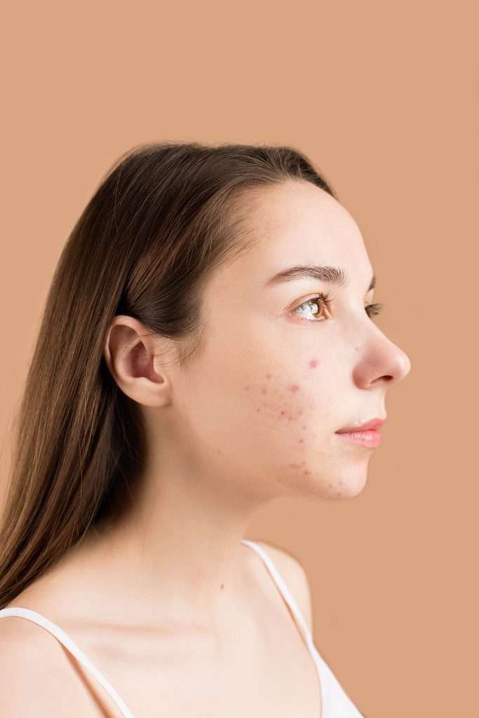 Da dầu mụn — Cách kiểm soát bã nhờn và ngăn ngừa mụn từ bên trong